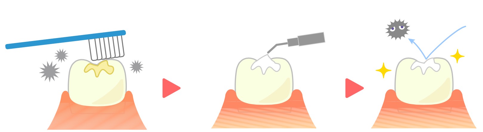Individualprophylaxe